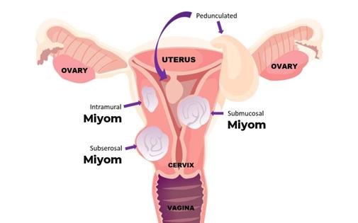 Miyom Sorununa Bitkisel Çözüm: Konforlu Bir Yaşam İçin