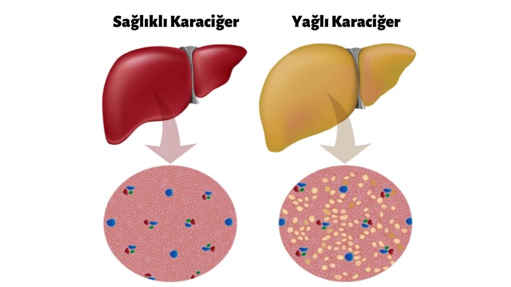 Karaciğer Yağlanması Tedavisi: Doğal Yollarla Detoks