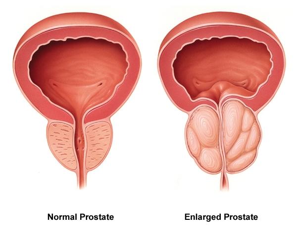 Prostat Problemlerine Doğal Yaklaşım: Rahatlama Yolları