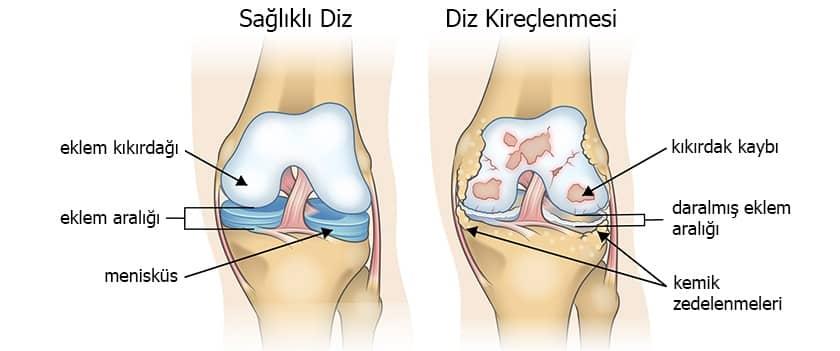Kireçlenme Ağrılarının Nedenleri ve Belirtileri