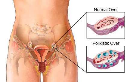 Polikistik Over (PCOS) Sorununa Doğal Yaklaşım: Hormonal Denge